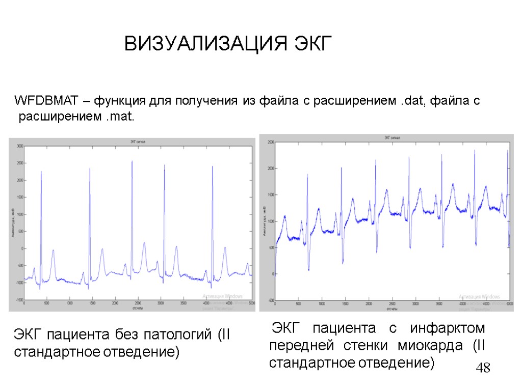 ВИЗУАЛИЗАЦИЯ ЭКГ 48 ЭКГ пациента без патологий (II стандартное отведение) ЭКГ пациента с инфарктом